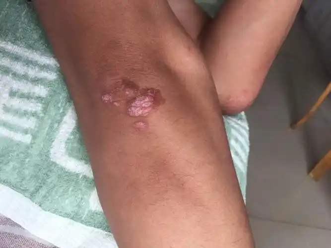 牛皮癣 不可怕 真实案例分享