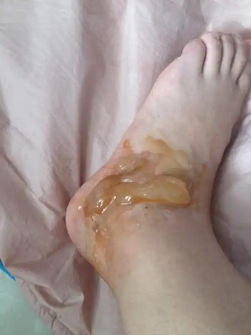 二级烫伤后恢复的图片_有来医生