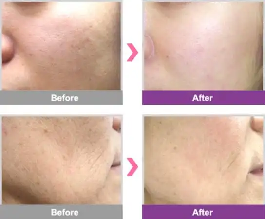 韩国史丹利皮肤管理前后对比案例