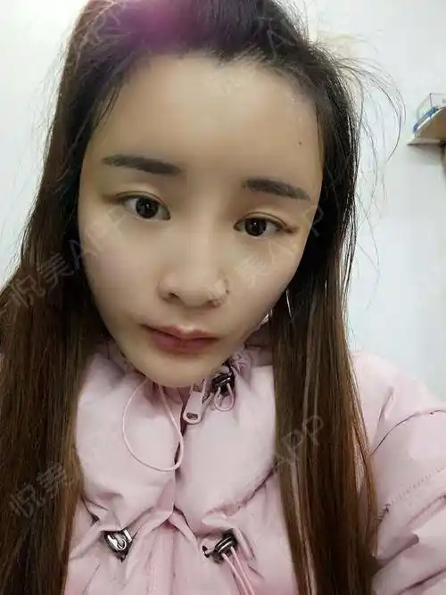 自体脂肪面部填充术后10天_面部填充术后10天_自体脂肪术后10天_面部