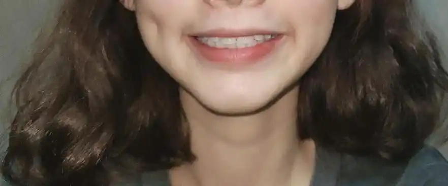 摘牙套后感觉变成了整齐的龅牙