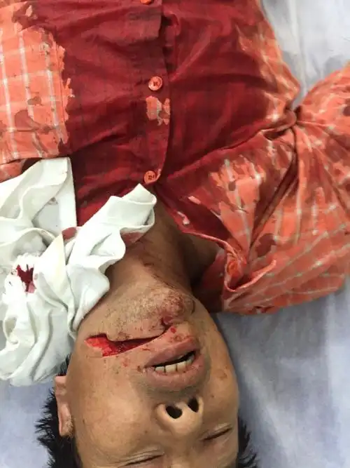 伤情鉴定是在出院以后才能鉴定吗?