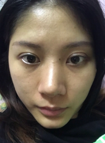 双眼皮失败修复|两侧不对称|宽修窄 填脂肪