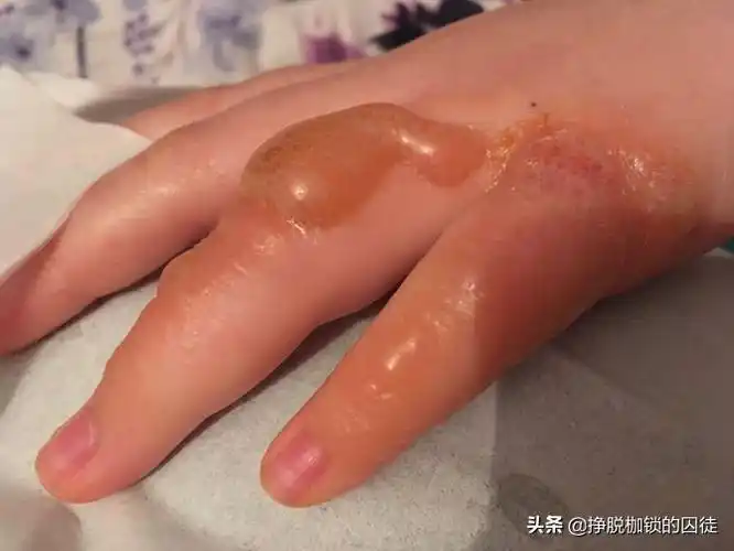 皮肤的热烧烫伤从损伤程度来说可以分成三度:一度烧伤:轻微的热损害