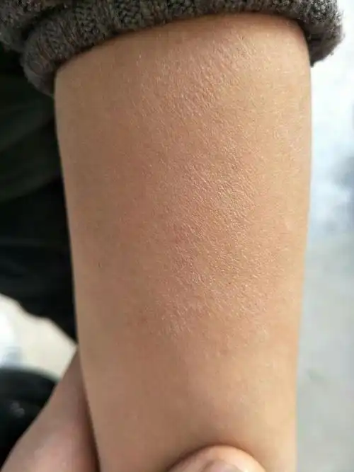 小朋友7岁,全身有皮屑,很痒.