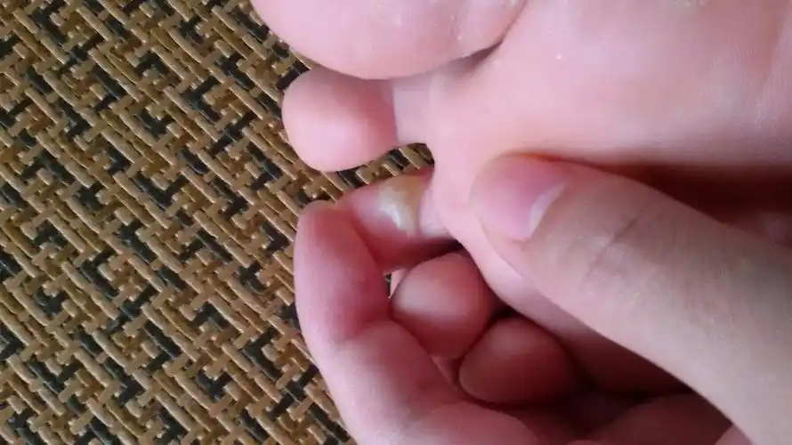 脚趾母长了个水泡,痛,火辣辣的,还很痒.