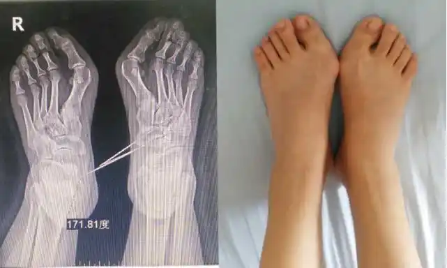 双足拇外翻矫正术还您美丽的双脚