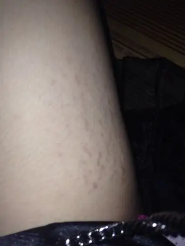 女17岁 160 50公斤 大腿内侧长了很多红色的条纹 不痛不痒 慢慢的大腿