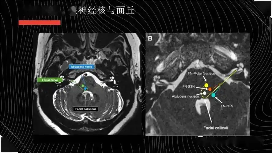 面神经解剖与常见疾病
