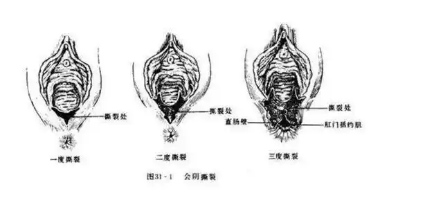 顺产的侧切或撕裂对以后有什么影响医生说的实情是