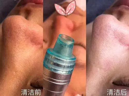 针对性的用小气泡毛孔洗澡清洁皮肤然后根据你的皮肤状况2适用于:皮肤