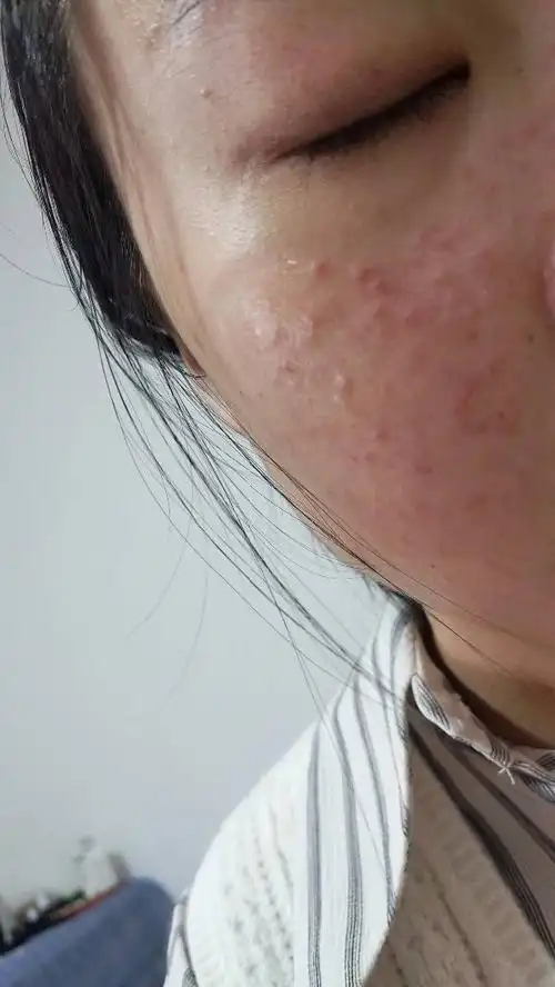 最近脸上起痘痘,是不是过敏,或者别的原因