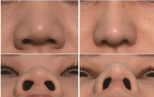 你知道吗鼻翼缩小多少钱有哪些手术方式哪里做得好