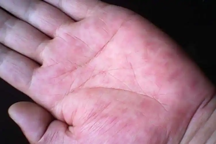 这种红肿号称"肝掌",是肝癌的征兆,你有这种症状吗?_手机搜狐网