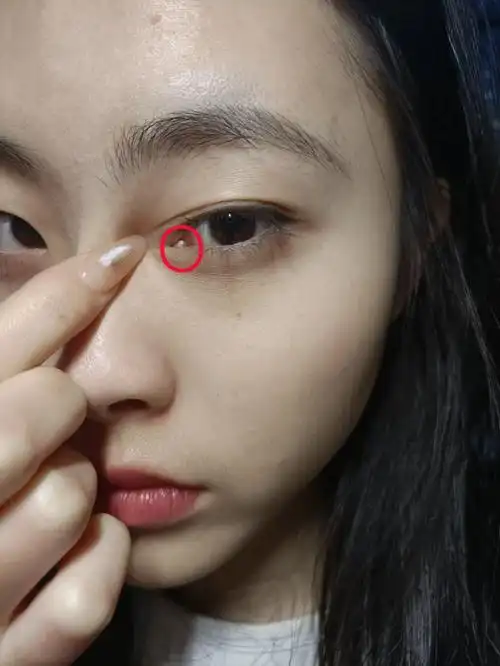 救命眼角这个地方有个肉球今天有点痛痛的发现越挤越大有东西流出来有