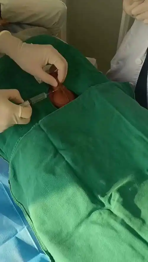 曼陀罗花园:吻合器包皮环切手术操作一气呵成,非常棒!