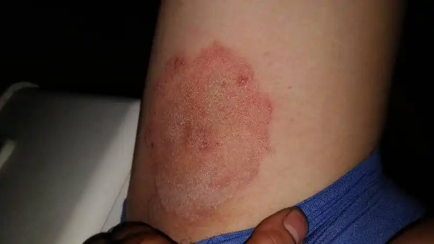 大腿内侧长的是啥啊 ,怎么治