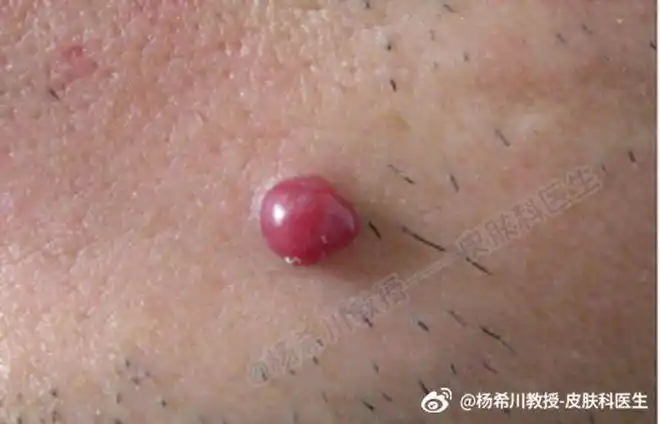 杨教授每周病例分享化脓性肉芽肿