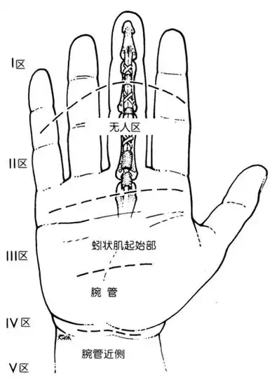腕管区Ⅳ区手掌区Ⅲ区腱鞘区Ⅱ区为"无人区",即中节指骨中份,伤后易