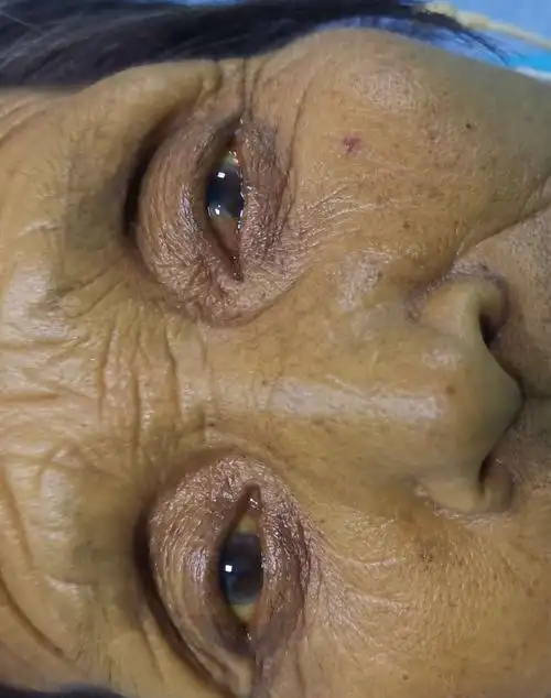 【梗阻性黄疸科普】胆囊切除术后1年,黄疸,肝右叶胆管扩张,介入微创