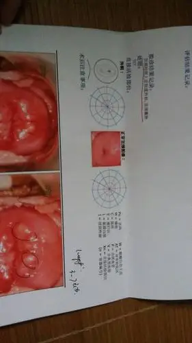 妇科疾病,有轻微的盆腔炎.