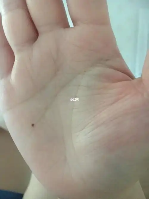 手心痣有什么意义