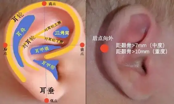 耳廓软骨发育中产生异常折叠;二,耳廓部位的皮肤和软骨缺失这也是造