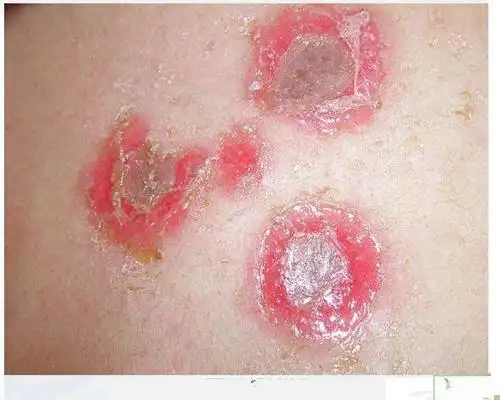 男性一期梅毒图片6