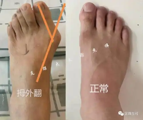 健康领域优质创作者 订阅 点击查看更多订阅内容> 1,为什么会得拇外翻