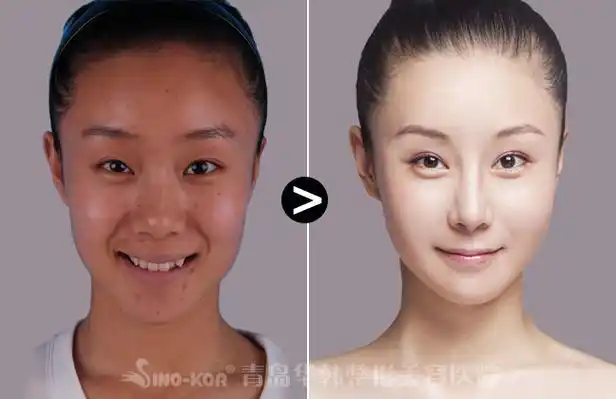 复合彩光嫩肤技术美白皮肤前后对比