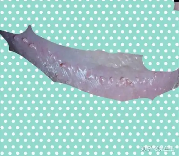 请大家帮忙看一下我这个是尖锐湿疣还是假性湿疣?