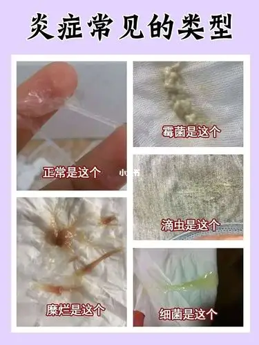 妇科炎症_炎症_私处护理_卫生巾_清洁_熬夜_药店_透气性_医疗健康