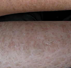 鱼鳞病为什么秋冬严重