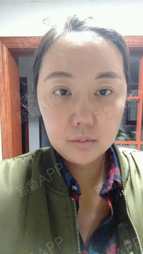 自体脂肪面部填充