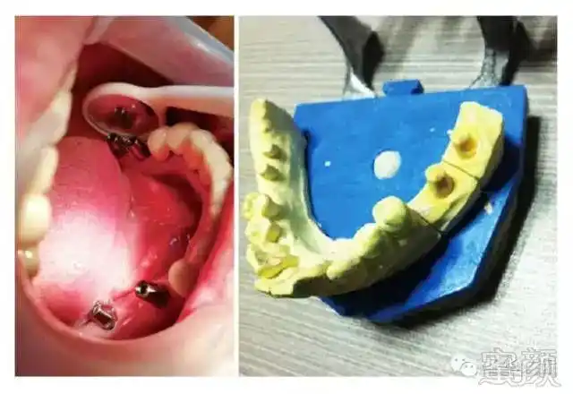 种植牙之取模篇