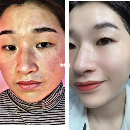 原相机对比真的干净了_相机_美白淡斑_皮肤问题_红血丝_素颜_美妆