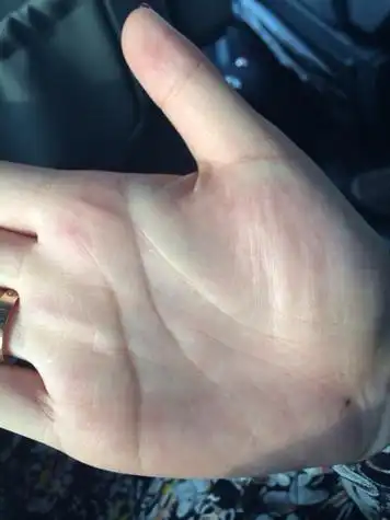 我是一个女的 为啥我右手没有事业线 手掌还有一颗痣