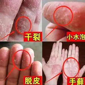 00中药草本美肤馆淘宝蓝银草专治手癣膏真菌感染鹅掌风汗疱疹干裂