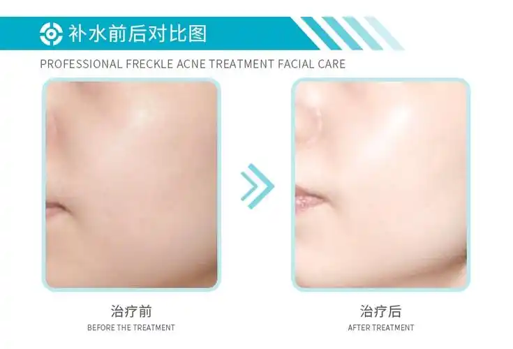 补水 修护四效合一皮肤屏障修复【小绿膜】葡聚糖修护面膜建议集美们