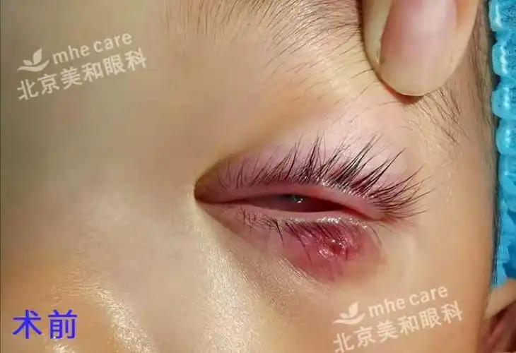 莫把霰粒肿当麦粒肿延误治疗eos超脉冲新疗法非手术治疗