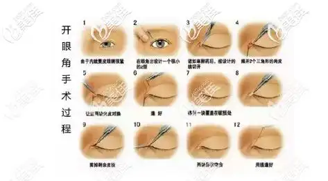 开眼角手术过程图解