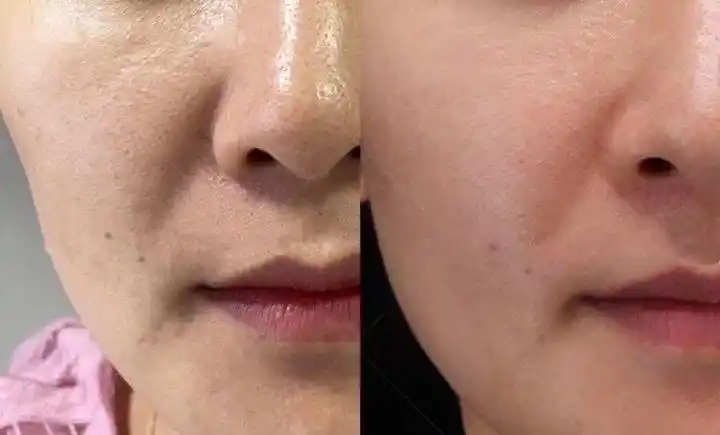 一,案例一(改善毛孔粗大,紧致皮肤)