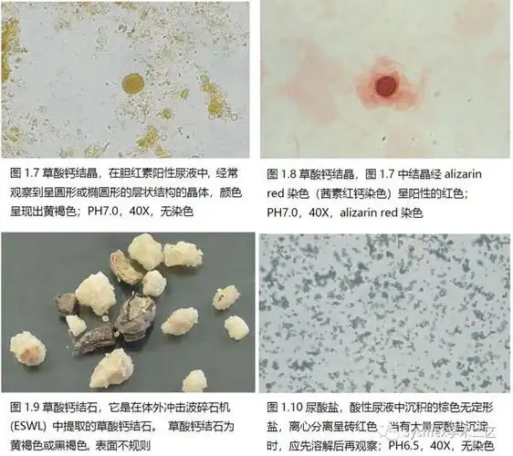 高清图谱尿液结晶形态汇总