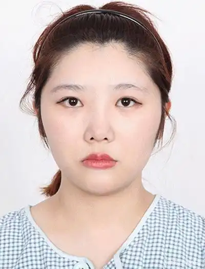 大脸妹子做颧骨内推,看到效果网友大呼羡慕!