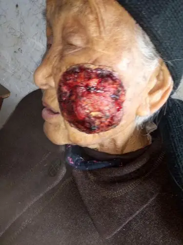 八十岁老人脸上长的这是什么