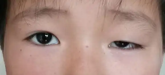 上睑下垂显无神,该如何"拯救"?割双眼皮就完事儿了吗?