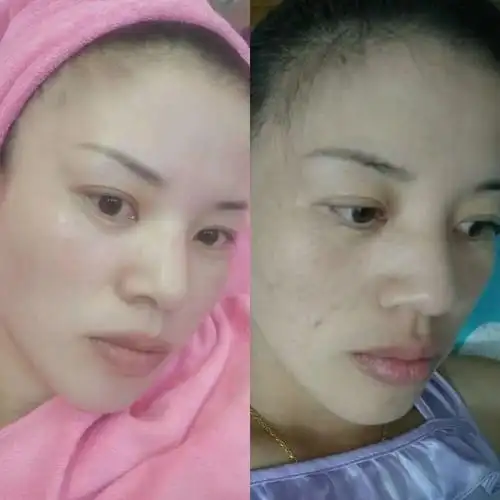 真人美白祛斑效果对比!