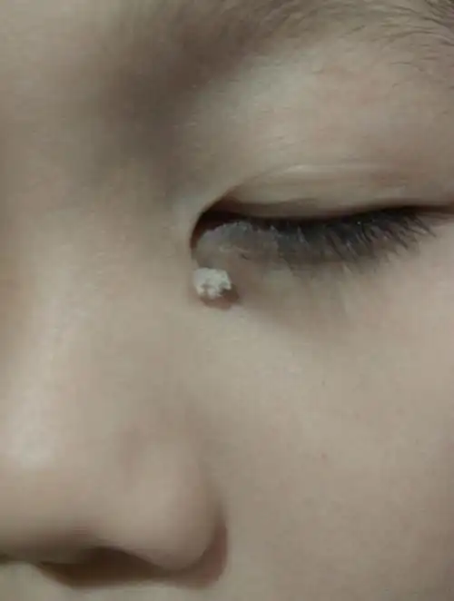 儿子眼角下长了个东西,问下是什么瘊子