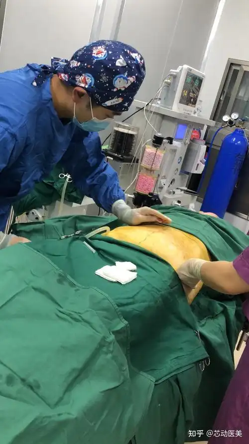 腹部吸脂后肚皮会松吗