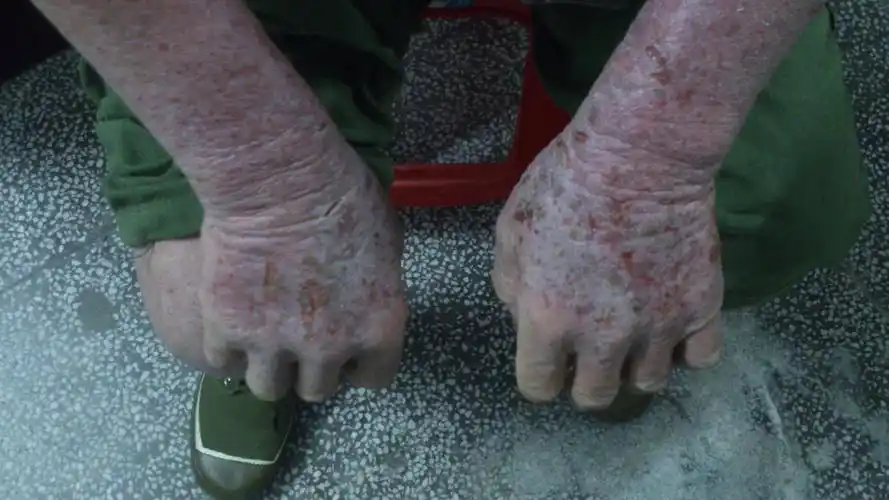 有请皮肤科专家看看这位大爷的皮肤病非常严重